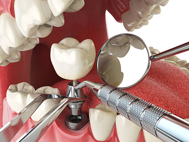 Best Emergency Wisdom Teeth Removal in Greenfield, TN